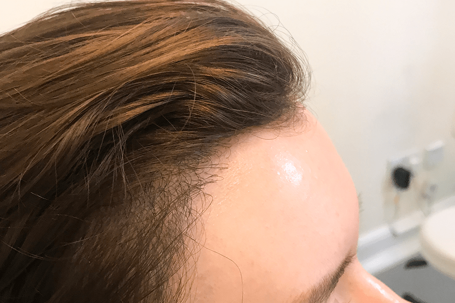 Female hair transplant after 2