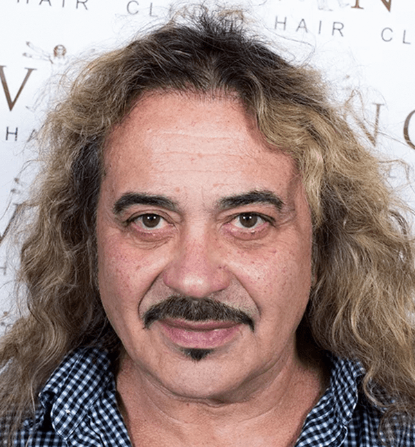 Wagner X Factor Hair Transplant after