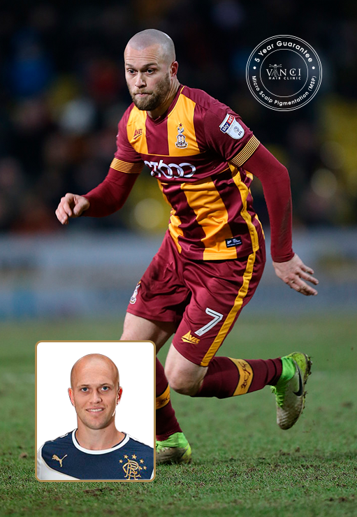 Nicholas Alexander Law - Football player perfomed the procedure of Micro Scalp Pigmentation at Vinci Hair Clinic