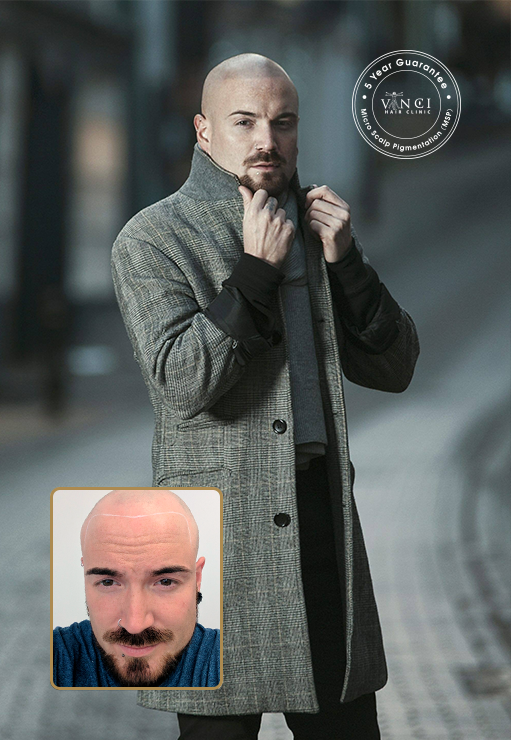 Joni George Valadares – Model performed the procedure of Micro Scalp Pigmentation at Vinci Hair Clinic