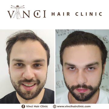HT-Vinci-Hair-Clinic-Caio-de-Souza-Brito-5-meses-Antes-1.png