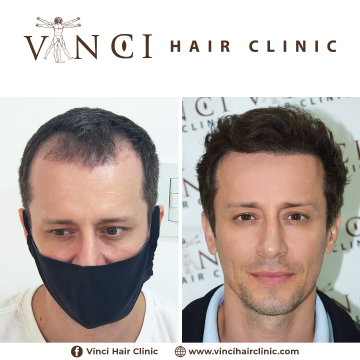 HT-Vinci-Hair-Clinic-Diogo-Scalon-10-meses-01.png