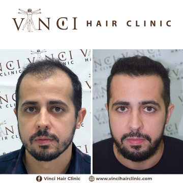 HT-Vinci-Hair-Clinic-Rafael-Ricardo-31yo-1900FUE-Brazil-1-year-1.png