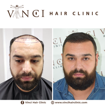 HT-Vinci-Hair-Clinic-Rodrigo-31yo-2000FUE-Brazil-15-12-2020-01.png