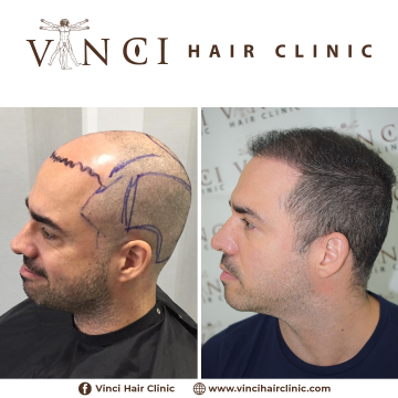 Vinci-Hair-Clinic-Emerson-Ticianelli-6-meses-2.png