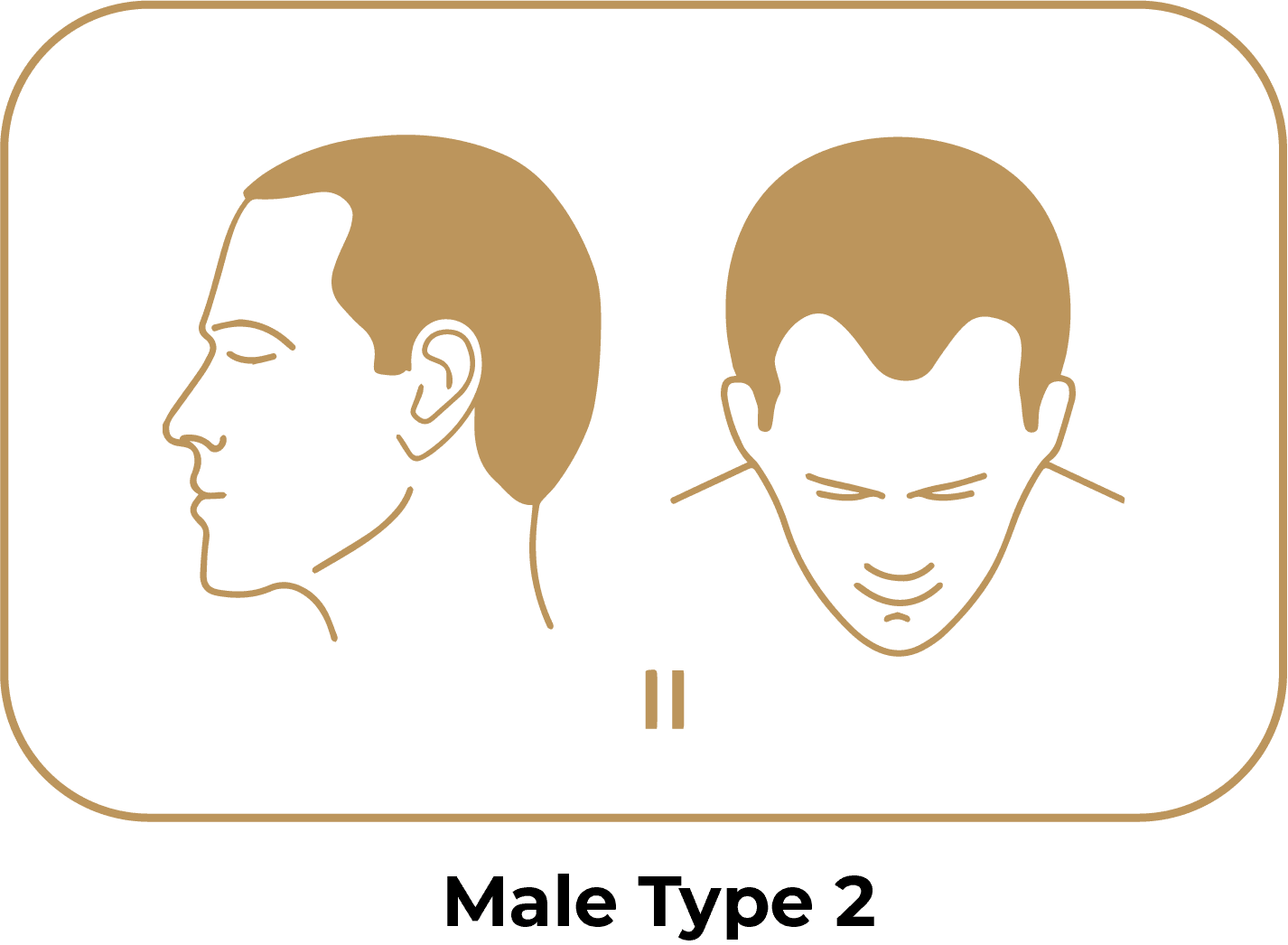 Norwood Scale 2