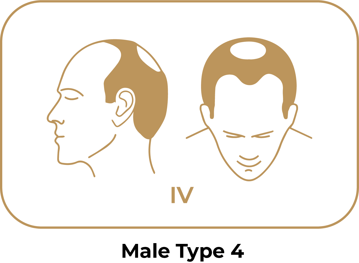 Norwood Scale 4