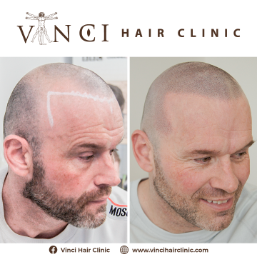 Vinci Hair Clinic – Visit one of our state of the art Micro Scalp ...