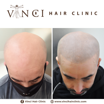 MSP-Vinci-Hair-Clinic-Amando44.png
