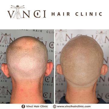 MSP-Vinci-Hair-Clinic-JOHN-KELLY-30-06-2021-5.png
