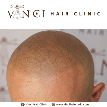 MSP-Vinci-Hair-Clinic-JOHN-KELLY-30-06-2021-6.png
