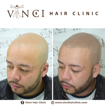 MSP-Vinci-Hair-Clinic-Jonathan-Firmino-Brazil-22-06-2021-03.png