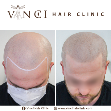 MSP-Vinci-Hair-Clinic-Manchester-19.05.2021-01.png