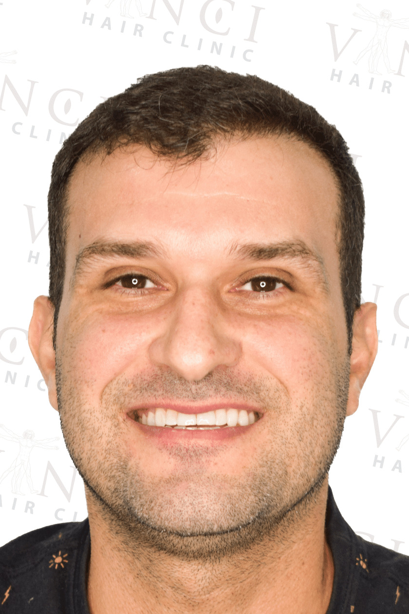 After hair transplant case showing a new hairline and mid scalp treatment