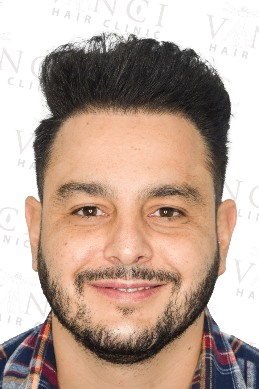 After hair transplant case focused on a new hairline treatment