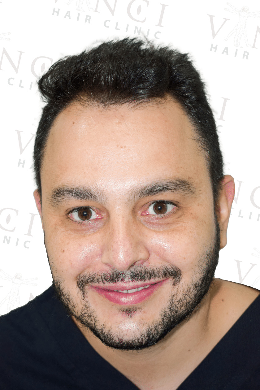 Before hair transplant case focused on a new hairline treatment