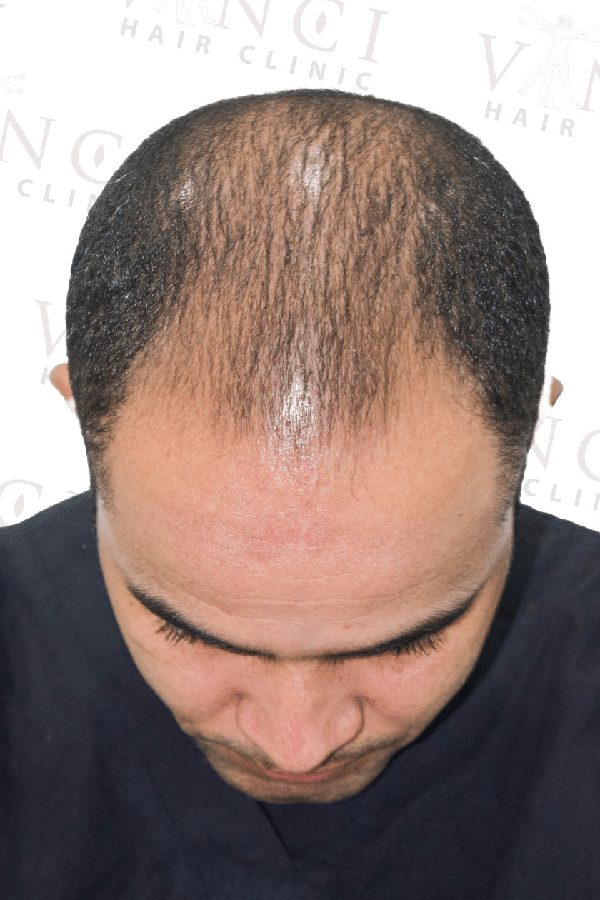 Before hair transplant case focused on increased density