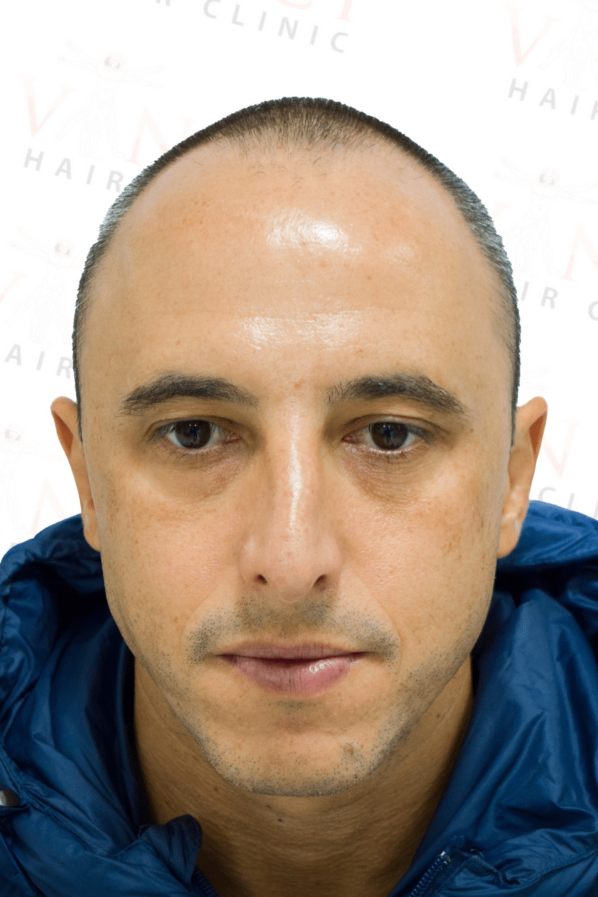 Before hair transplant case focused on a new hairline treatment