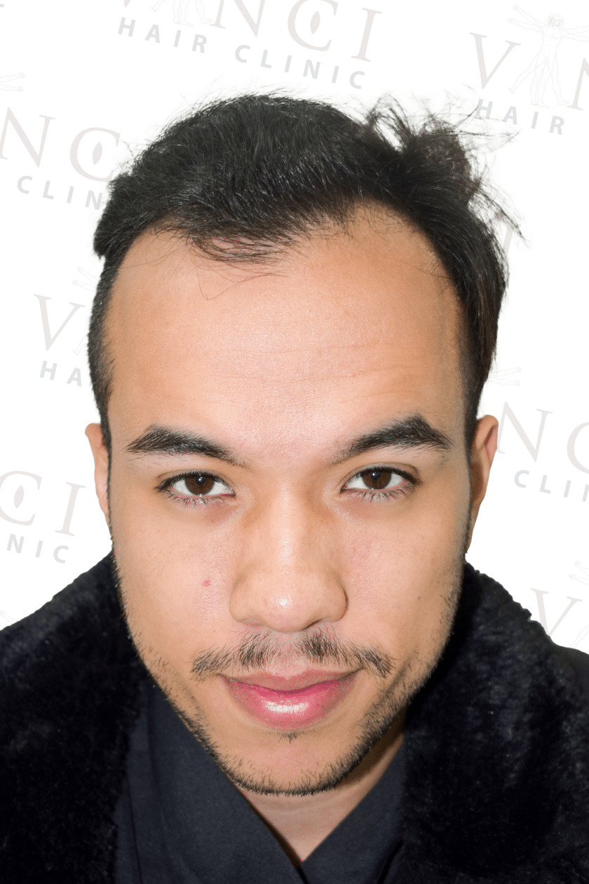 Before hair transplant case focused on a new hairline treatment