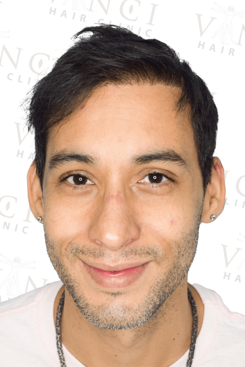 After hair transplant case showing complete hair restoration at Vinci Hair Clinic
