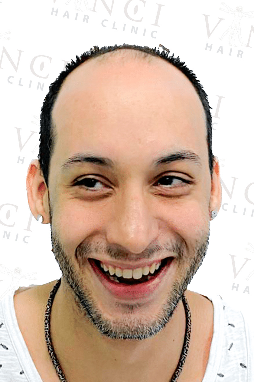 Before hair transplant case showing complete hair restoration at Vinci Hair Clinic