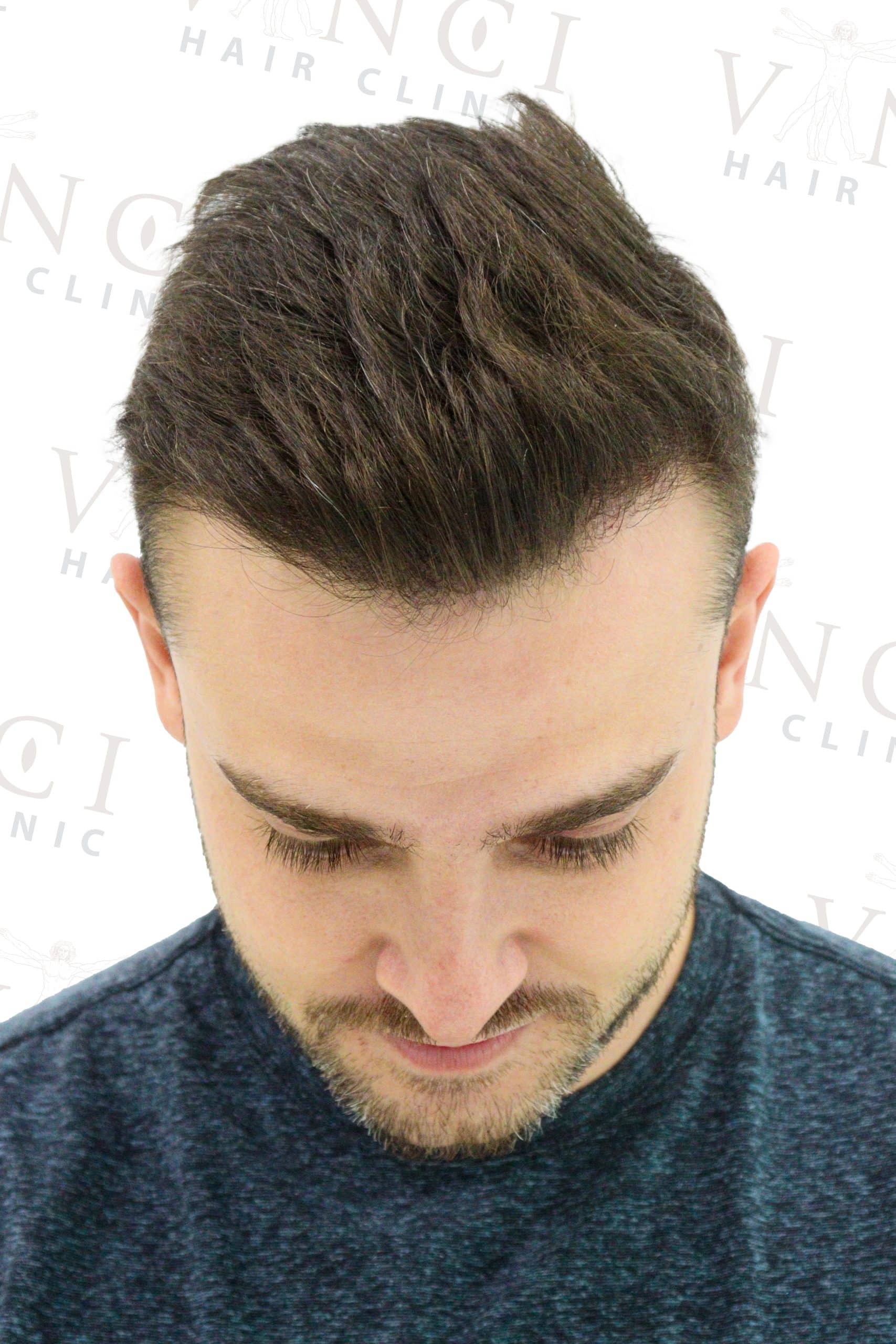 After hair transplant case focused on a new hairline treatment