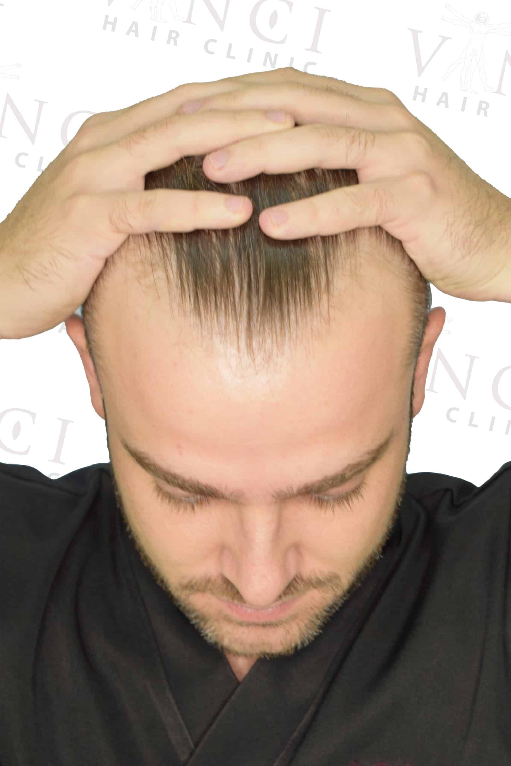 Before hair transplant case focused on a new hairline treatment