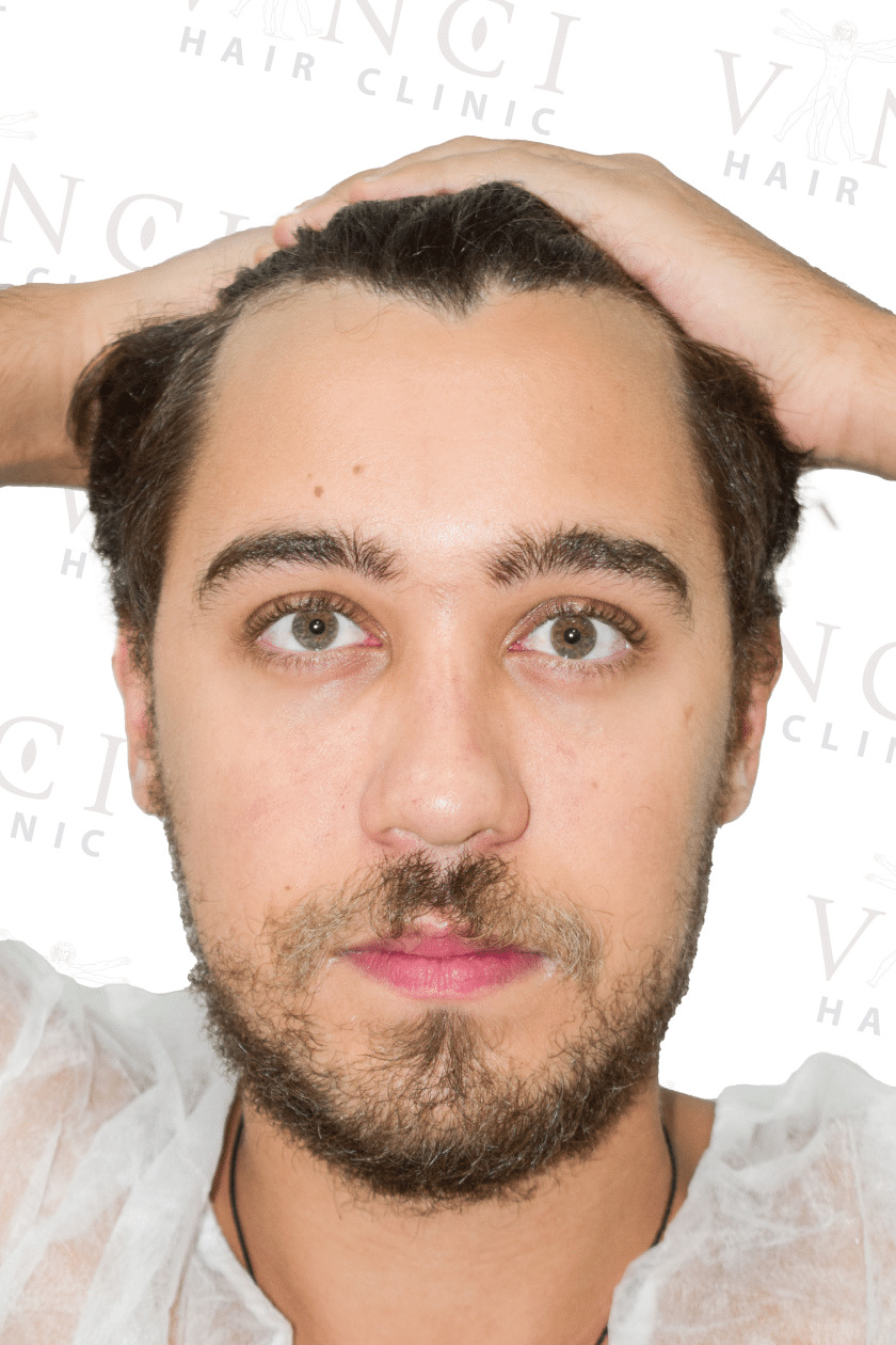 Before hair transplant case focused on forehead reduction