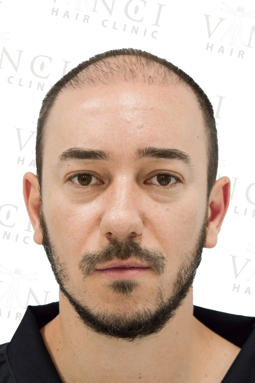Before hair transplant case showing a new hairline and mid scalp treatment