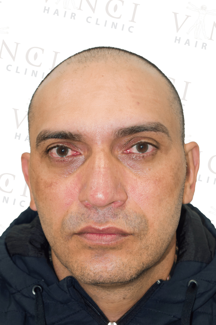 Before hair transplant case showing a new hairline and mid scalp treatment