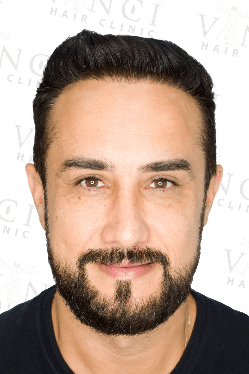 After hair transplant case showing a new hairline and mid scalp treatment