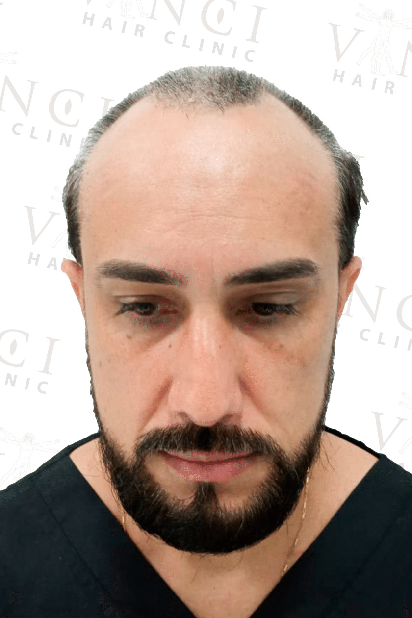 Before hair transplant case showing a new hairline and mid scalp treatment