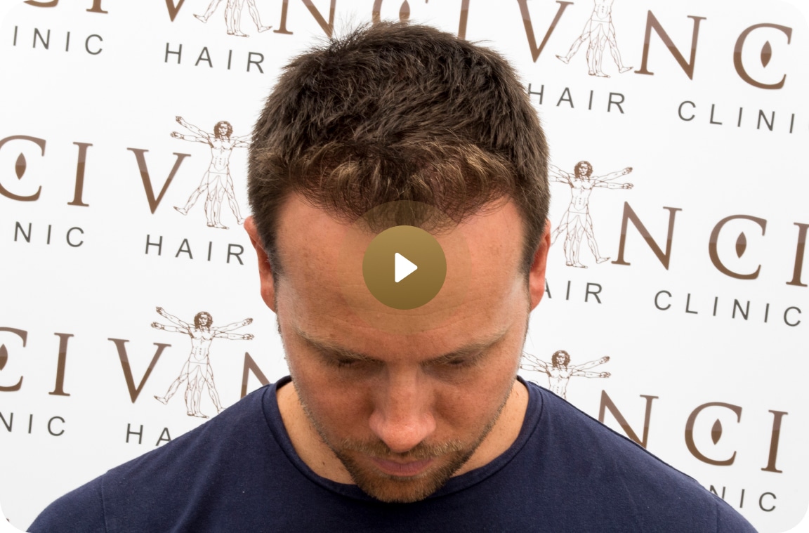 Video thumbnail of @dankoek after treatment with Vinci Hair Clinic