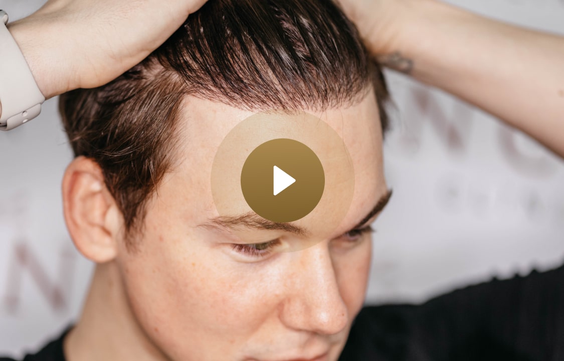Gregory Gage showing his hair transplant progress with Vinci Hair Clinic