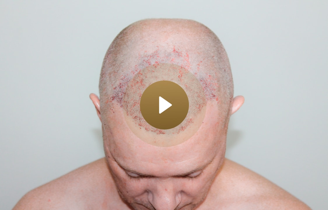 Neil showing his hair transplant recovery with Vinci Hair Clinic