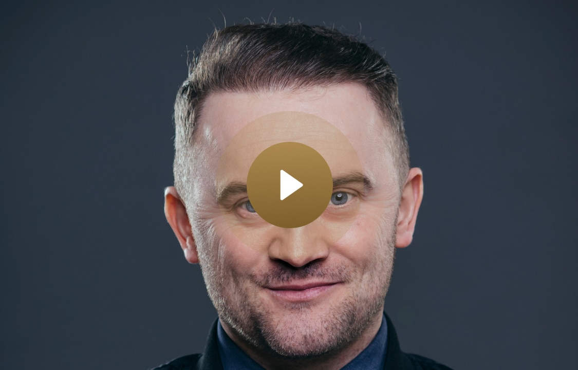 Stephen Purdon sharing his Vinci Hair Clinic hair transplant results