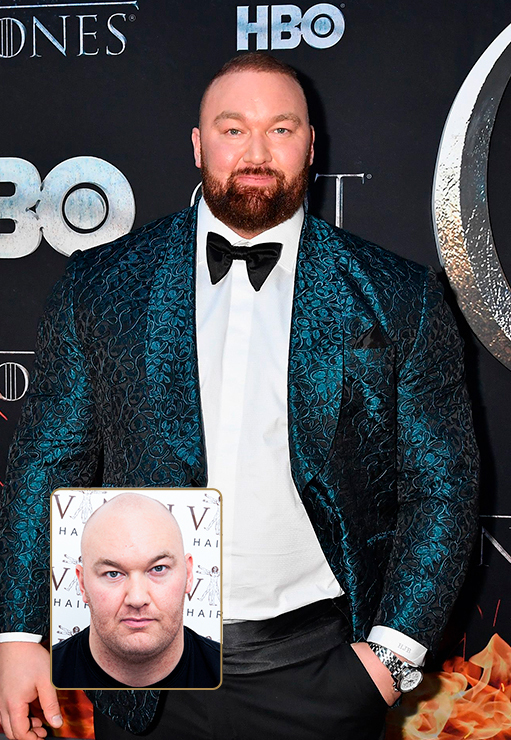 Hafthór Júlíus Björnsson – Ser Gregor “The Mountain” Clegane de Game of Thrones did the Hair Transplant procedure at Vinci Hair Clinic in 2018.