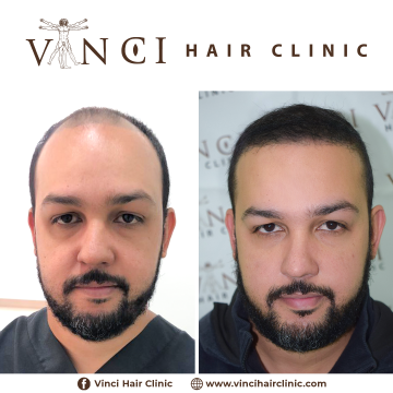 Fernando Jose Pereira FUE Hair Transplant