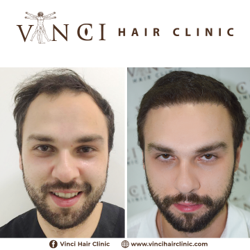 HT Vinci Hair Clinic Caio de Souza Brito 5 meses Antes 1