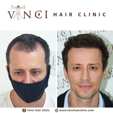 HT Vinci Hair Clinic Diogo Scalon 10 meses 01