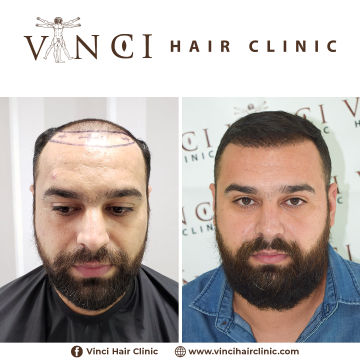 HT - Vinci Hair Clinic Rodrigo 31yo - 2000FUE - Brazil 15-12-2020 01