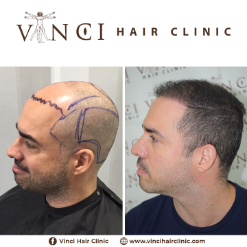 Vinci Hair Clinic Emerson Ticianelli 6 meses (2)