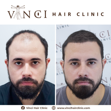 William_Transplante_Capilar_FUE_Int_01