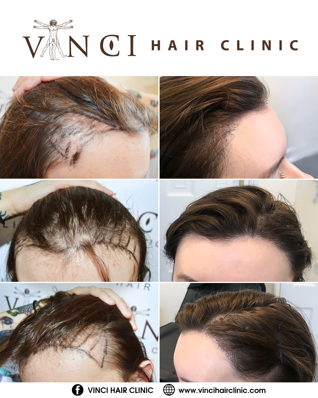 Parietal scalp is another affected area in female pattern hair loss: a |  CCID