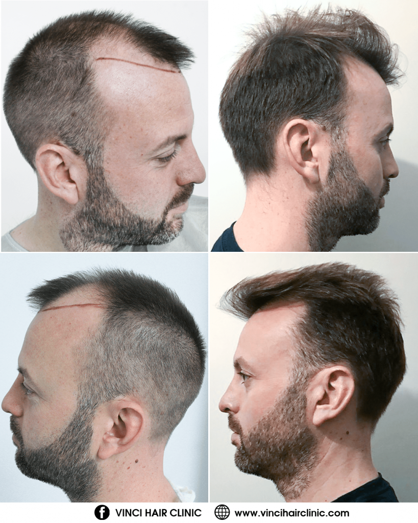 Vinci Hair Clinic CHRIS WALSH 12 MTH FUE RESULTS