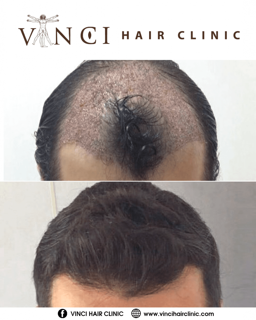 Vinci Hair Clinic HT