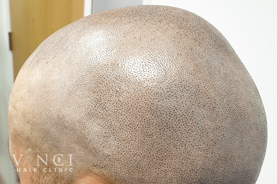 Alopecia Areata vincihair