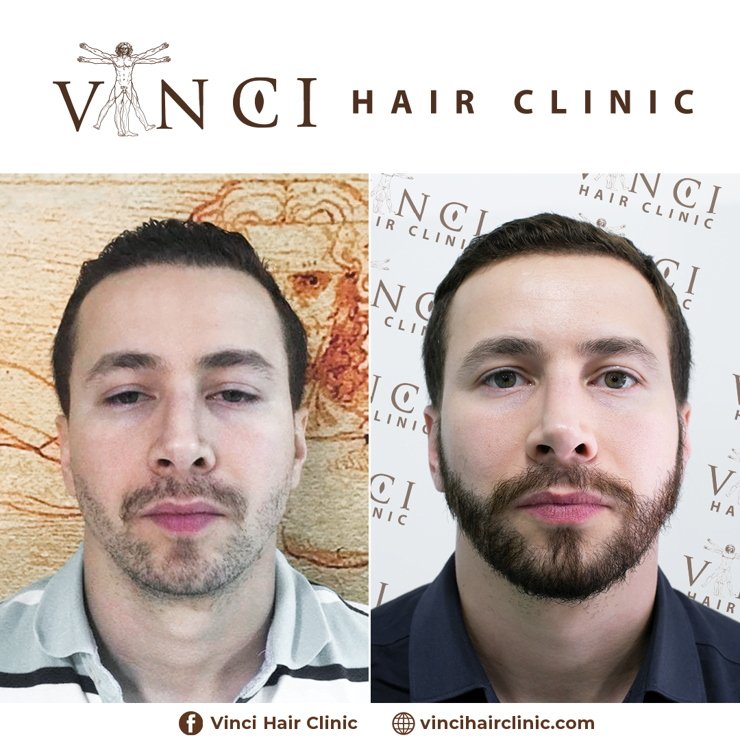 A man before and after a beard transplant at Vinci Hair Clinic, with no beard transplant scars