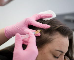 Close-up of a woman receiving mesotherapy treatment at Vinci Hair Clinic, one of our Female hair loss remedies. Highlighting the precision and care involved in the process as she undergoes this advanced hair rejuvenation procedure.