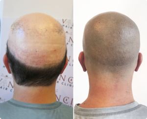 Before and after showing the remarkable transformation a patient with alopecia achieved through Vinci Hair Clinic MSP